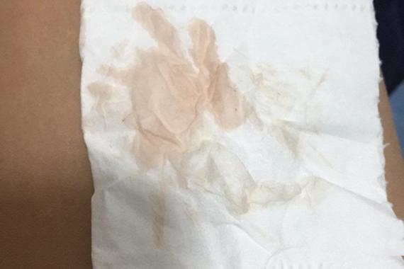 着床成功后出血图片解析：正常症状与异常情况对比指南（附高清图）